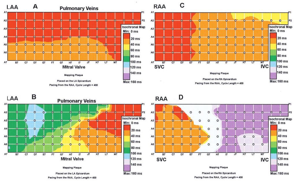 Figure 9. Epicardial electrical activity maps: before and after linear lesion creation. (A) An isochronal map of the left atrium (LA) during right atrial appendage (RAA) pacing at 400-ms cycle length.