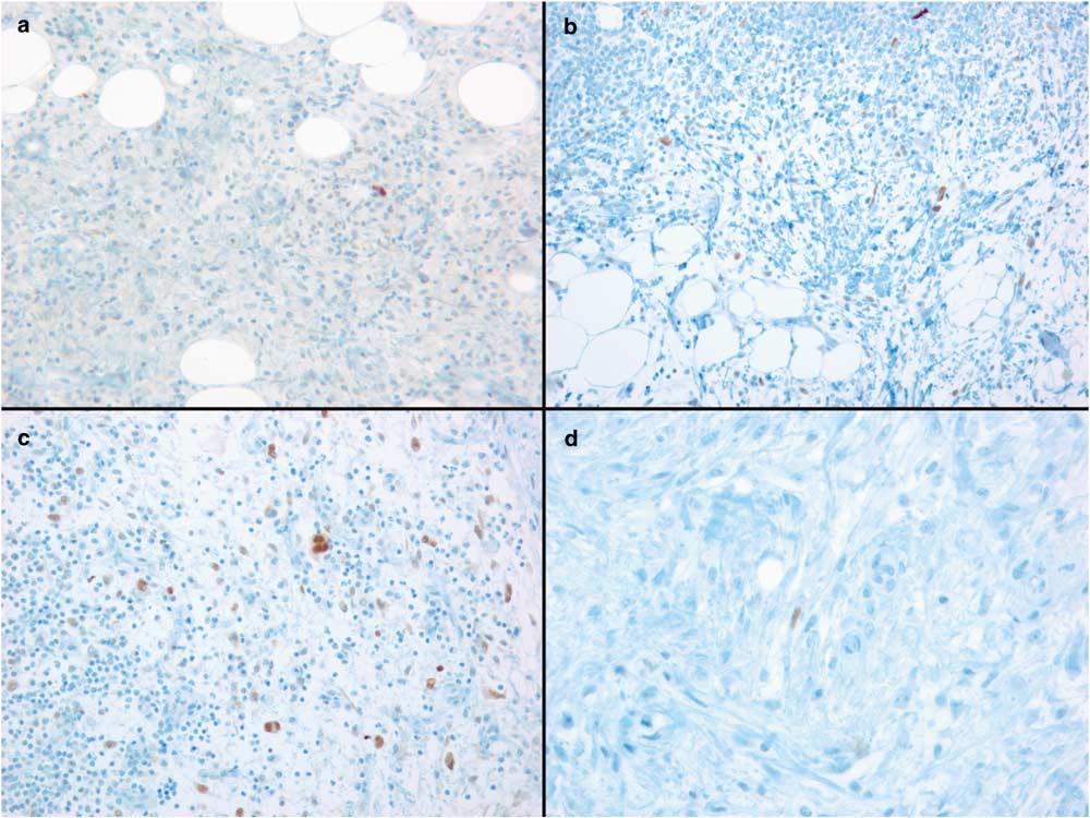 68 Immunostained slides were evaluated by the two independent soft tissue pathologists (JRG and BPR), discordant cases were reevaluated collegially.