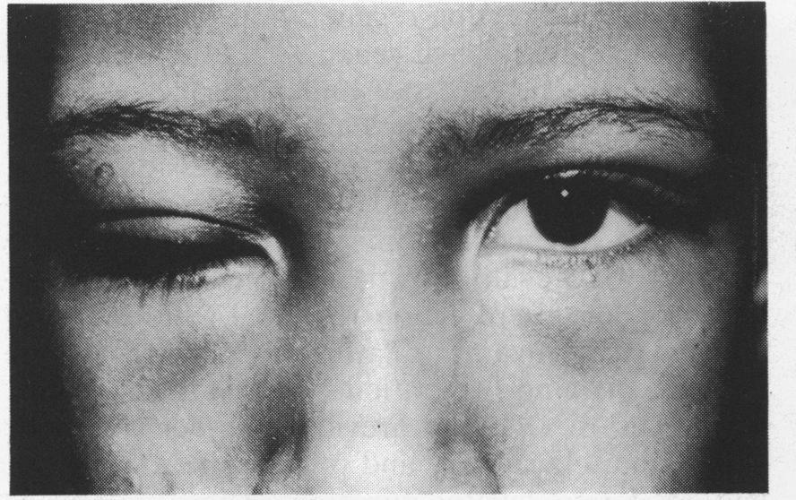 The fourth patient had poor levator function and gained improvement rather than correction of the hypotropia and pseudoptosis.