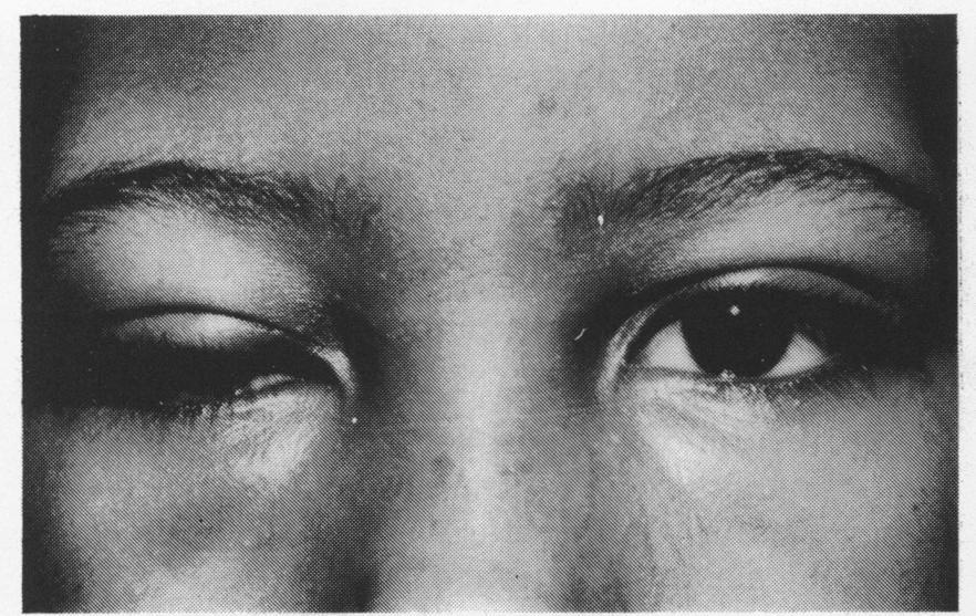 The element of real ptosis was corrected to within 1 mm, with acceptable cosmesis, in 13 cases with surgery based on the guidelines relating levator function to the amount of levator resection