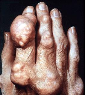 Gout: accumulation of