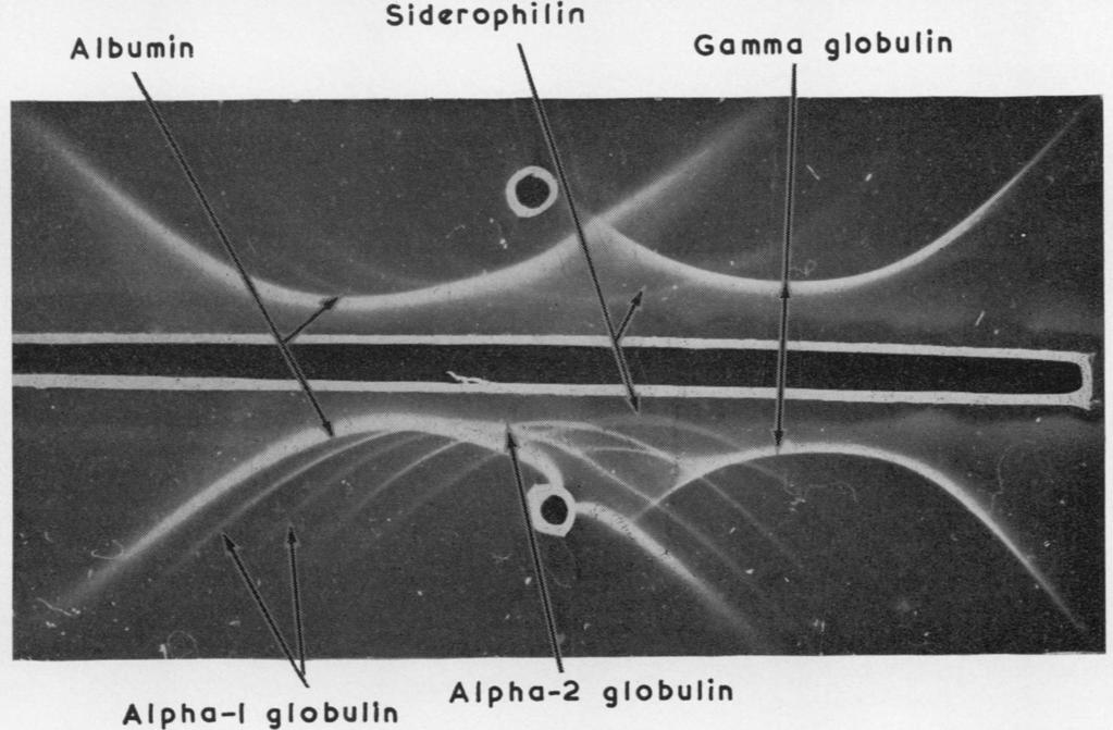 IMMUNO-ELECTROPHORETIC ANAL YSIS OF PROTEINS Albumin Alpha-I Ik globulin Siderophi lin Alpha-2 globulin Gamma globulin Fig. 6.-Upper: chronic nephrotic syndrome (proteinuria 18 g./litre).
