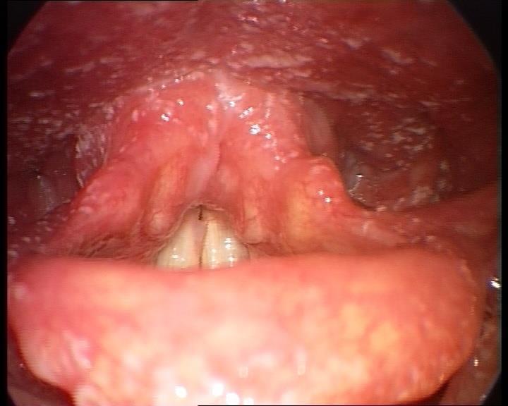Oropharyngeal mycosis Painful & mechanical dysphagia May cause aphagia.