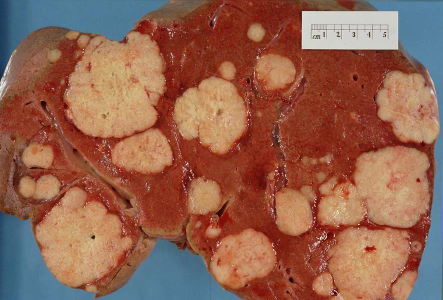 Benign tumor: does not spread to surrounding healthy tissue b.