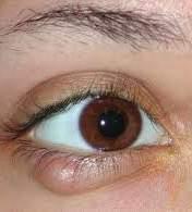 Benign Eyelid Lesions: Chalazia May drain spontaneously or persist as a chronic nodule Recurrent lesions need to exclude a