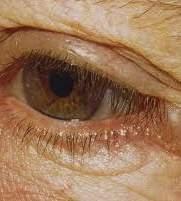 Benign Eyelid Lesions: Apocrine Hidrocystoma Do not increase in size in