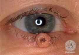 Pre-Malignant Eyelid Lesions: Keratoacanthoma Lesion on the eyelids may