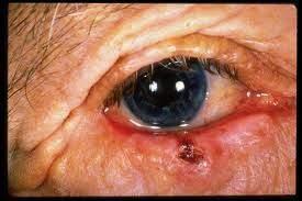 Malignant Eyelid Lesions: Basal Cell Carcinoma (BCC)