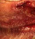 Malignant Eyelid Lesions: Squamous Cell Carcinoma (SCC)