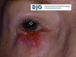 Malignant Eyelid Lesions: Sebaceous Gland Carcinoma Relatively rare, 1/3 most