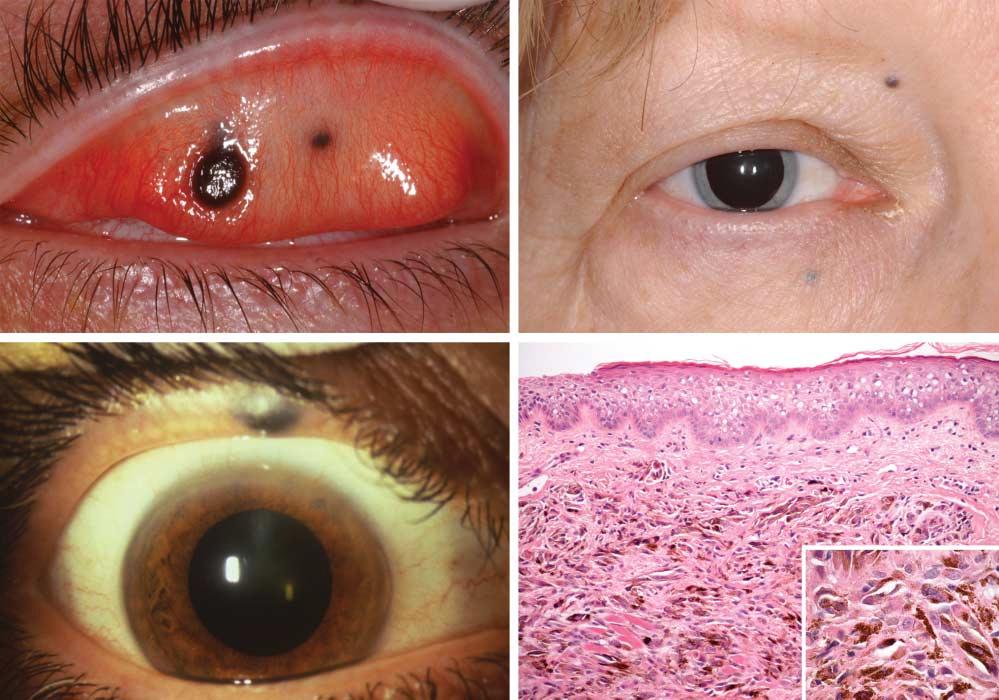 A C D Figure 2. Examples of pigmented metastases from primary melanoma. A, Two pigmented metastases in the tarsal conjunctiva of the left upper eyelid from cutaneous melanoma in a man aged 33 years.
