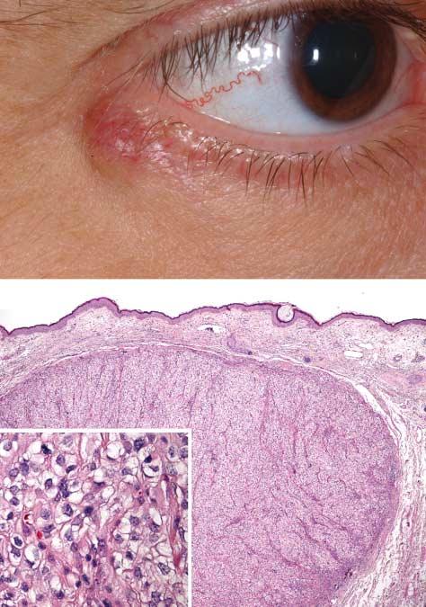 A A Figure 3. Metastasis from renal cell carcinoma. A, Solitary metastasis in the right lower eyelid margin in a man aged 47 years.
