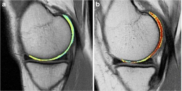 Advanced 3D Quantitative MRI Analysis To assess sustainability, completeness of bone and cartilage defect filling, and cartilage quality, applied to both 6-Month and 8-Year data sets T2 Mapping