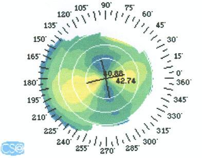 Stability of procedure was evaluated by the variability of the mean topographic astigmatism through 2 nd and 6 th months postoperative follow-up examinations (Figure 2).
