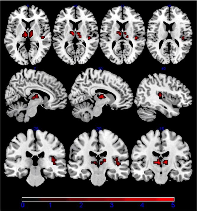 Brain Plasticity in MS Thalamus (and insula): Increased functional connectivity the brain has to work harder fatigue! Liu et al. (2011).