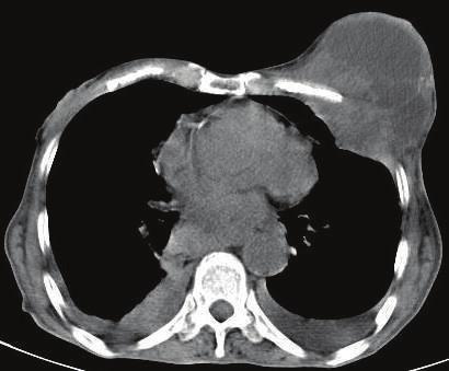 Figure 3: Oral and intravenous contrast-enhanced CT scan of the chest revealed bilateral pleural effusions with mass involving the left chest muscles and