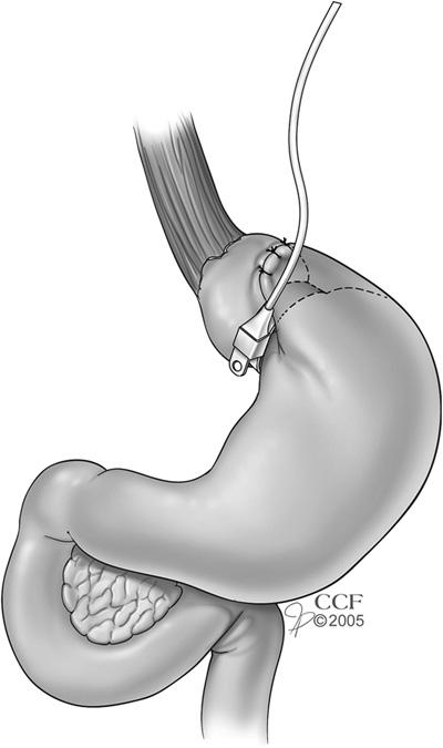 FIG 3-1. Adjustable gastric banding. An adjustable band is placed around the upper stomach to create a 15 20 ml gastric pouch above the band.