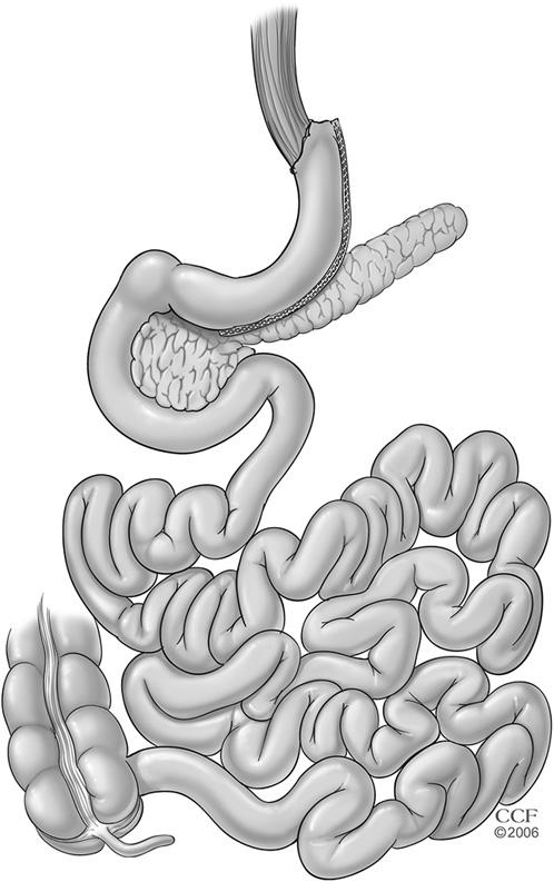 FIG 3-2. Sleeve gastrectomy. The stomach is stapled vertically to remove most of the body and fundus to achieve 75% gastric volume reduction.