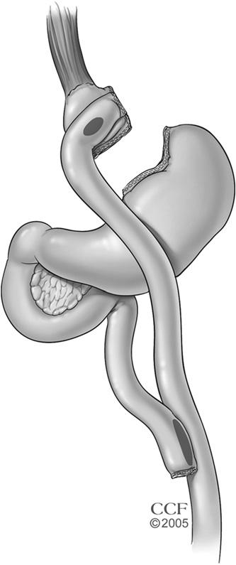FIG 3-3. Roux-en-Y gastric bypass. The stomach is stapled to create a 15 20 ml gastric pouch isolated from the remaining stomach.