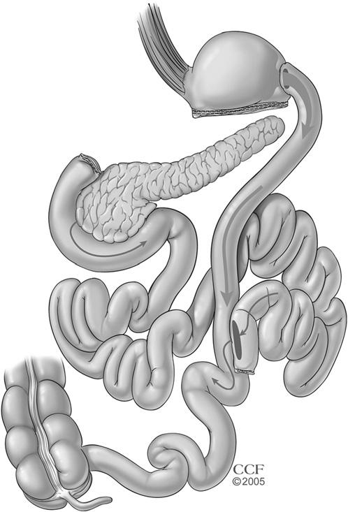 FIG 3-4. Biliopancreatic diversion. The stomach is stapled to create an approximately 250 ml gastric pouch, and the remaining stomach is removed.