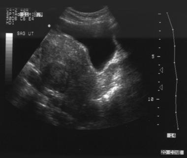 Ultrasound Transabdominal