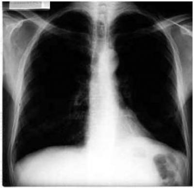 Figure 8 but there was no trauma to the abdomen or thorax. The patient was not treated seriously first coming to the emergency service, because of his history of epigastric pain and peptic ulcer.