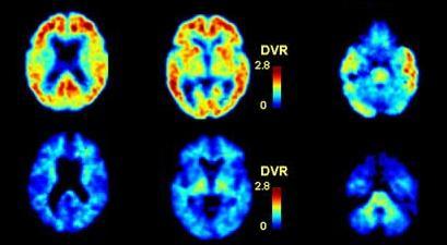 Amyloid Scanning In AD Subject and