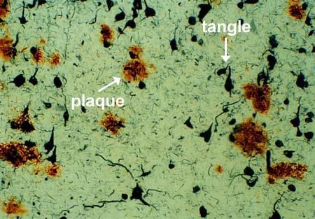 Alzheimer s disease Identified in 1910 Progressive disorder marked by amyloid plaque and neurofibrillary tangle pathology Estimated