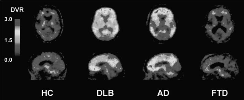 In vivo PET Amyloid imaging in aging and dementia