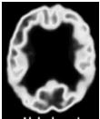 (total and phos ) Hippocampal atrophy on MRI FDG