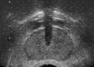 Ultrasound Prostate Urethra