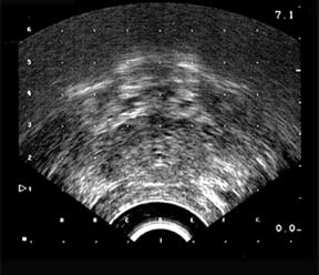 Ultrasound Apex / GUD