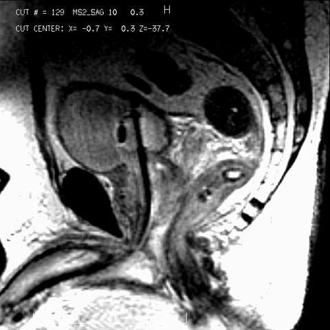 MR Anatomy Prostate Urethra Rectal wall Corpus Cavernosum