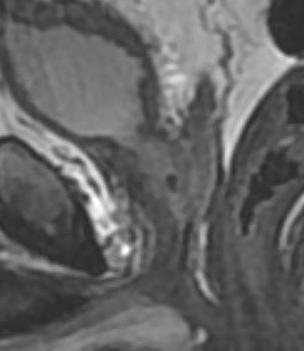bladder seminal vesicle bone prostate rectum external sphincter Proximal penis Prostate side