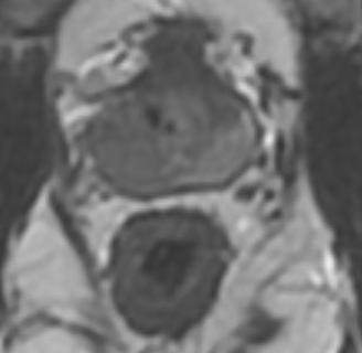 Right side of the gland panel is normal prostate