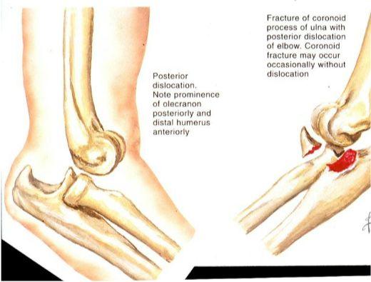 Dislocation and fracture of the ulna: Falling on a flexed elbow can cause a fracture in the coronoid process of the ulna and breakaway. This may cause a dislocation of the elbow joint.
