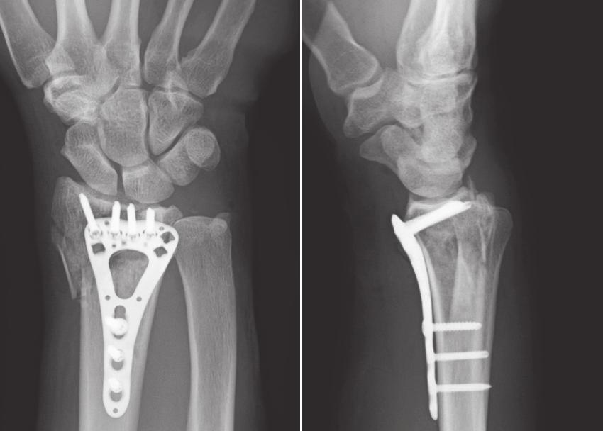 dorsally displaced distal radius fractures. Fig.