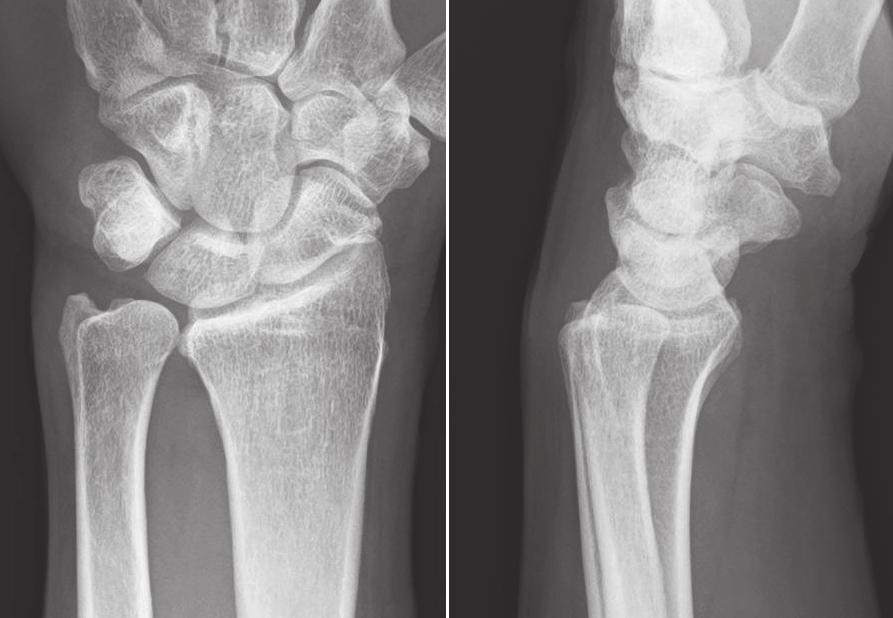 554 Takaaki Shinohara and Hitoshi Hirata Fig. 4 Posteroanterior and lateral radiographs of the unaffected wrist showing 3.5-mm ulnar plus variance. short arm cast for 3 weeks.