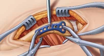Step 1: Exposure Step 2: Plate Placement Approximately a six cm transverse (medial to lateral) incision is made over the palpable distal third fracture of the clavicle.