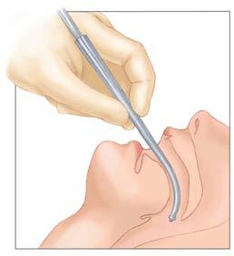 than 300 mmhg when collecting tube is clamped Rigid Pharyngeal