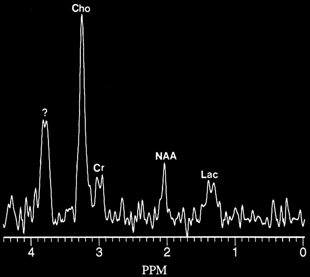 Interestingly relatively enhanced Glx resonance, which was almost comparable with the intensity of Cho, were observed in 4 