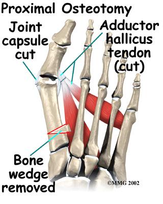 The basic considerations in performing any surgical procedure for hallux valgus are to remove the bunion to realign the bones that make up the big toe to balance the muscles around the joint so the