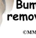 Bunionette Removal To remove the prominence, the