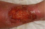 Slide 37 Venous Leg Ulcers Shallow wound that occurs when the leg veins can t return blood back toward the heart