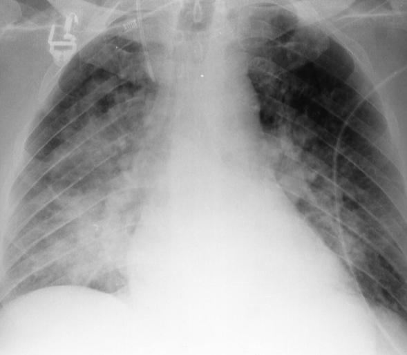 Periodontal disease and respiratory disease aspiration pneumonia is the most common cause of death in institutionalised elderly pateints aspiration pneumonia