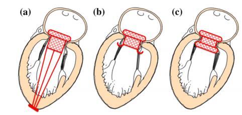 Transcatheter mitral valve replacement Characteristics of