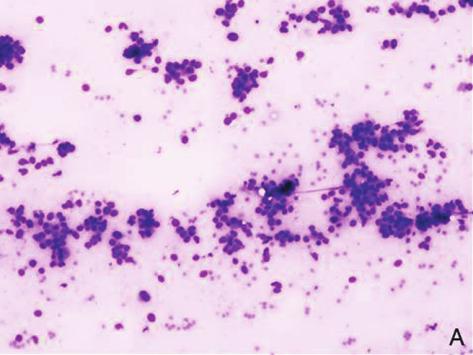 International Breast Cancer 3 (a) (b) (c) (d) Figure 1: (a) Cases diagnosed as C3 lesion showing slight loss of cohesion of cells (MGG Stain, 100).