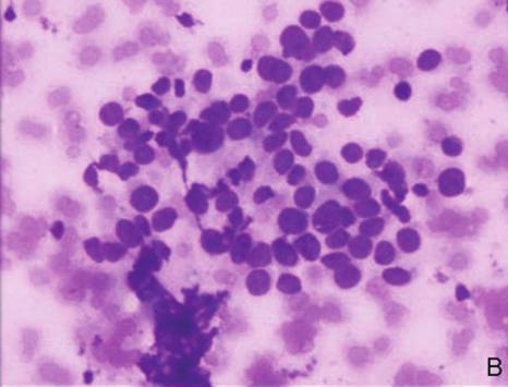 (c) Cases diagnosed as C4 lesion showing discohesive cells with moderate nuclear atypia (MGG Stain, 100).