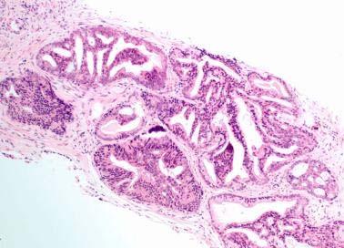 IDC-P: Hallmark Histological Features PIN4-ERG Numerous large branching glands with loose