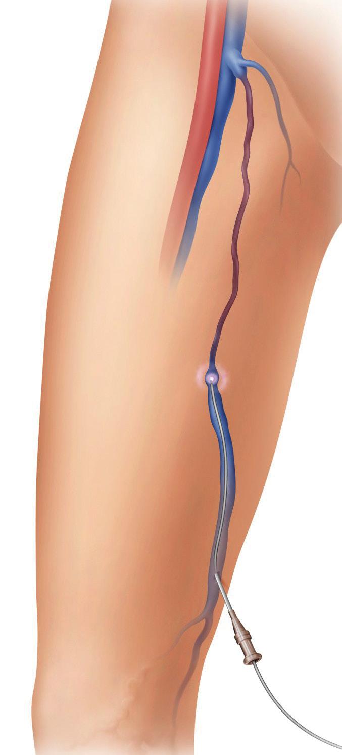 Saphenofemoral Junction Femoral Artery Femoral Vein Laser Fiber The VenaCure EVLT laser vein treatment procedure uses targeted laser energy to seal the vein shut and helps you look and feel better